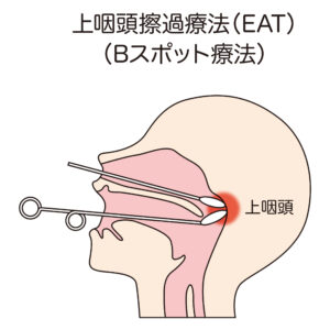 Bスポット療法